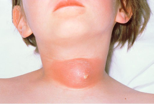Skin abscess: MedlinePlus Medical Encyclopedia