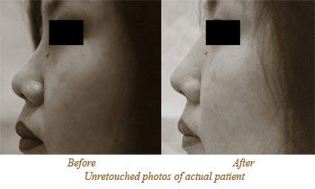 Example of Asian nose job - rhinoplasty for asians