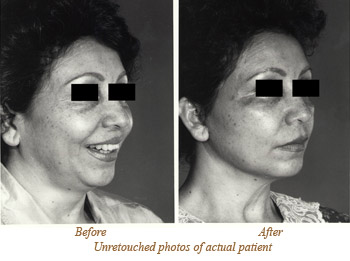 Facelift for women in New York City