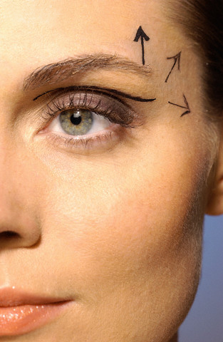 Blepharoplasty - eye lifts in New York City