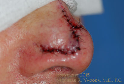 MOHs resection of cancer on the nose, BEFORE repair, set 2