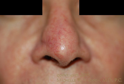 MOHs resection of cancer on the nose, AFTER repair, set 3