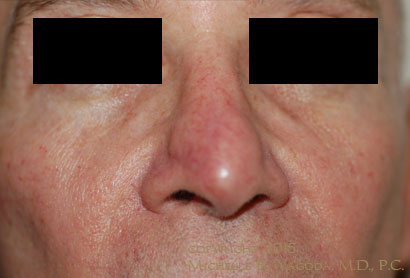 MOHs resection of cancer on the nose, BEFORE repair, set 3