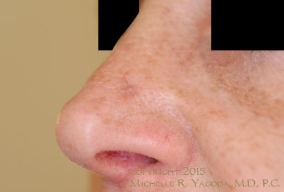 MOHs resection of cancer on the nose, AFTER repair, set 1