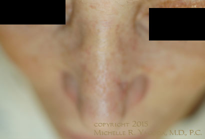 MOHs resection of cancer on the nose, AFTER repair, set 2