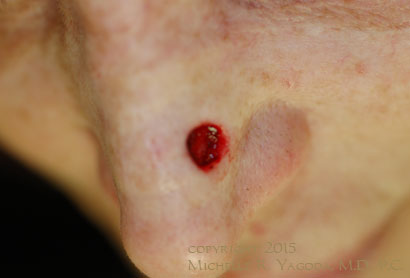 MOHs resection of cancer on the nose, BEFORE repair, set 2