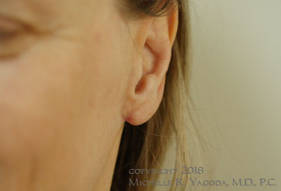 This 47 year-old woman underwent revision bilateral otoplasty to correct the left earlobe. It is smaller, closer to her head, and no longer flared out.