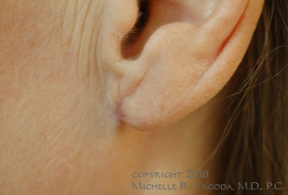 This 47 year-old woman underwent revision bilateral otoplasty to correct the left earlobe. It is smaller, closer to her head, and no longer flared out.
