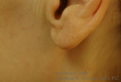 This 47 year-old woman had bilateral otoplasty as a child, but was never happy with the result. She thought that the left earlobe was too large, too protruberant, and too flared out.