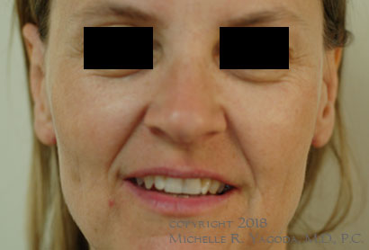 This 47 year-old woman underwent revision bilateral otoplasty to correct the left earlobe. It is smaller, closer to her head, and no longer flared out.
