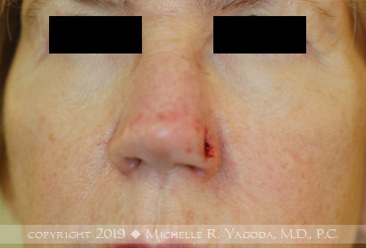 This 68 year-old woman underwent MOHs resection of a basal cell carcinoma of the nose which needed plastic surgery repair so as not to distort her appearance or restrict her breathing.