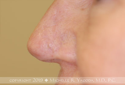 This 68 year-old woman underwent repair of MOHs defect after removal of a basal cell carcinoma of the nose. This restored her appearance without restricting her breathing.
