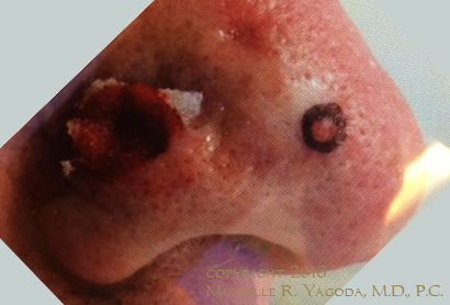 MOHs resection of cancer on the nose, BEFORE repair, set 1