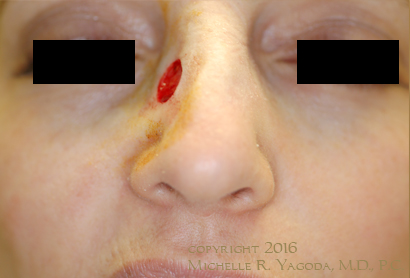 MOHs resection of cancer on the nose, BEFORE repair, set 1
