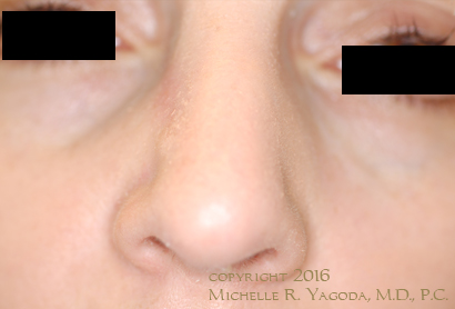 This 42 year-old woman underwent repair of a MOHs defect (3 months earlier) after resection of a basal cell carcinoma of her nose.