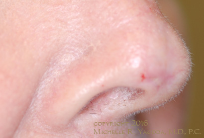 This 69 year-old woman underwent advancement flap rotation and functional rhinoplasty repair after resection of a basal cell carcinoma by MOHs. She did NOT want a composite graft from the ear, a full-thickness skin graft from the neck, or skin rotated from her cheek or forehead for the repair.