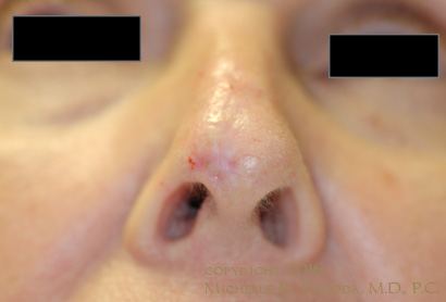 This 69 year-old woman underwent advancement flap rotation and functional rhinoplasty repair after resection of a basal cell carcinoma by MOHs. She did NOT want a composite graft from the ear, a full-thickness skin graft from the neck, or skin rotated from her cheek or forehead for the repair.