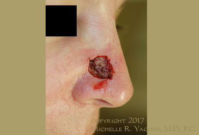 This 45 year-old woman underwent basal cell carcinoma of the nose which crossed into two nasal subunits., set 1
