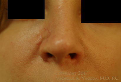 This 45 year-old woman underwent functional reconstructive rhinoplasty with advanced and combined flap reconstruction to repair the defect left after MOHs resection of a deeply infiltrating basal cell carcinoma of the nose which crossed into two nasal subunits. Complicated repair was required to prevent nasal valve collapse.
