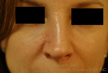This 45 year-old woman underwent functional reconstructive rhinoplasty with advanced and combined flap reconstruction to repair the defect left after MOHs resection of a deeply infiltrating basal cell carcinoma of the nose which crossed into two nasal subunits. Complicated repair was required to prevent nasal valve collapse.