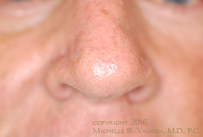 MOHs resection of cancer on the nose, AFTER repair, set 1