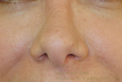 This 46 year-old woman underwent rhinoplasty surgery to narrow the tip of her nose and lift the bridge.