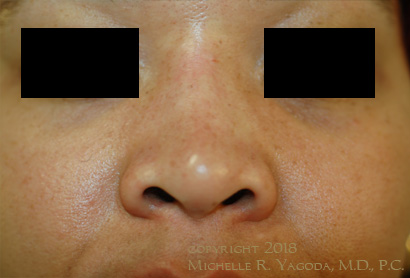 This 38 year-old woman underwent non-surgical rhinoplasty to raise the bridge of her nose and refine the tip.
