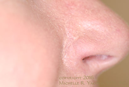 This 54 year-old woman underwent cosmetic and functional nasal repair after resection of a basal cell carcinoma of the nose by MOHs technique.  (3 months post-op)