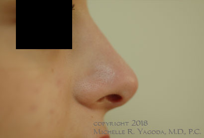 This 25 year-old petite female underwent finesse rhinoplasty to refine the tip of her nose, and remove the bump so that her nose would be in harmony with the rest of her face and body.