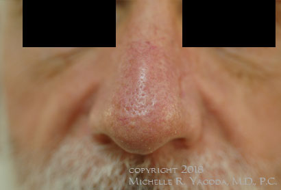 This 65 year-old gentleman underwent wide excision of a melanoma of his nose, and primary repair.
