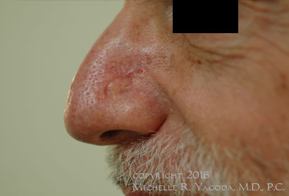 This 65 year-old gentleman underwent wide excision of a melanoma of his nose, and primary repair.