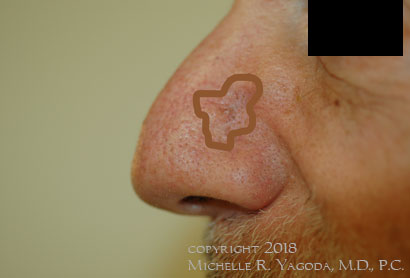 This 65 year-old gentleman had a melanoma of the left side of his nose.