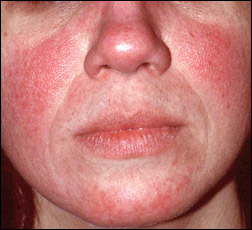 Facts: Rosacea